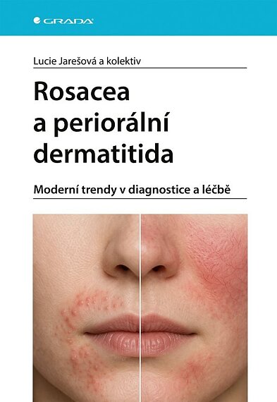 Rosacea a periorální dermetitida